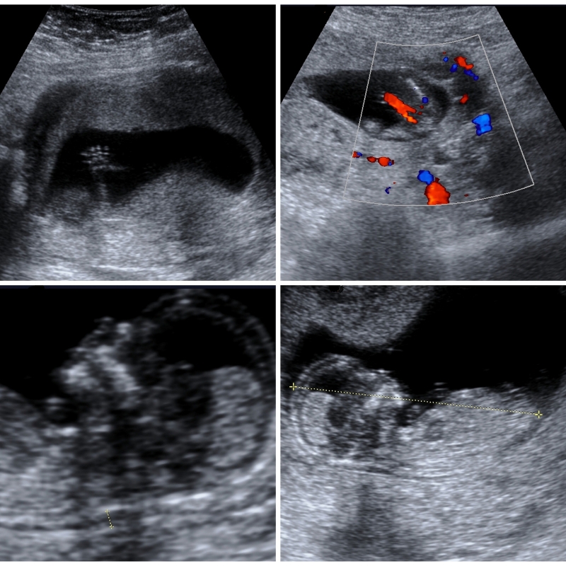 pregnancy ultrasound scan in leytonstone
