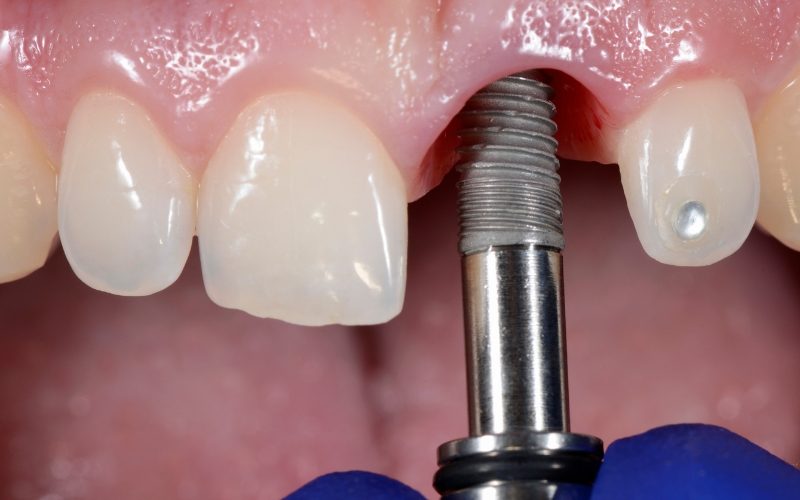 affordable dental implants leytonstone