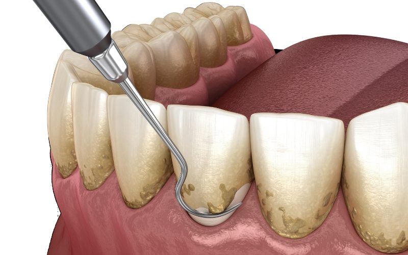 gum disease treatment in leytonstone